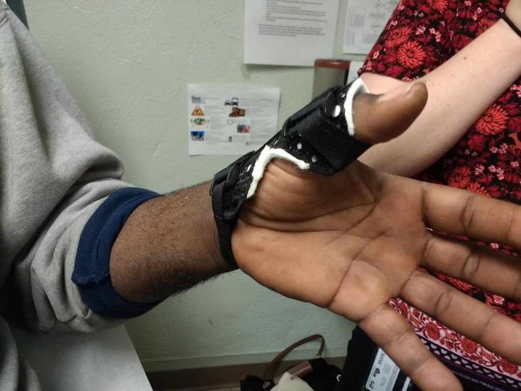 Splint that has been 3D printed in a material of an appropriate skin color and fit to a client's hand.